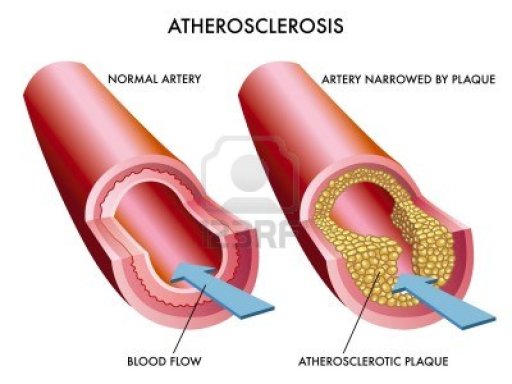 aterosclerosis