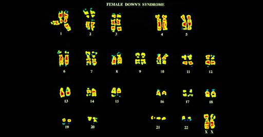 cromosomas sindrome de down