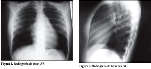 hipertenció pulmonar