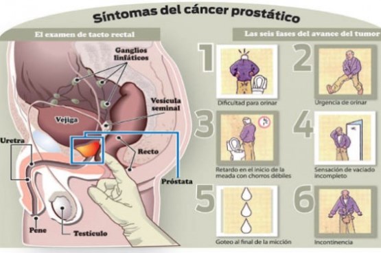cancer prostata