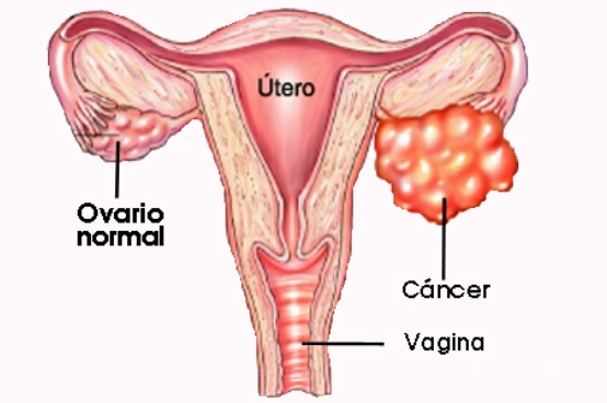 cancer ovario