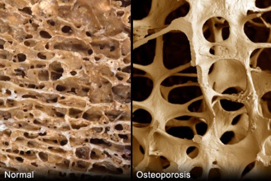 osteoporosis